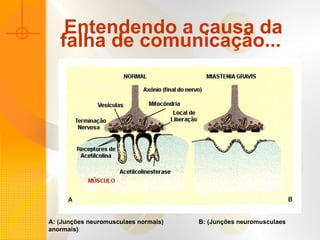 Entendendo a causa da falha de comunicação...   A: (Junções neuromusculaes normais)  B: (Junções neuromusculaes anormais) 