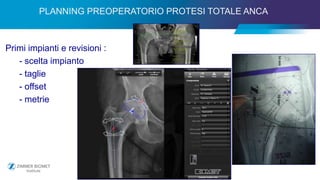 PLANNING PREOPERATORIO PROTESI TOTALE ANCA
Primi impianti e revisioni :
- scelta impianto
- taglie
- offset
- metrie
 