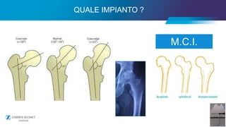 13
M.C.I.
QUALE IMPIANTO ?
 