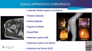21
• Laterale diretta supino e sul fianco
• Postero-laterale
• Antero-laterale
• Inguino-mediale
• SuperPath
• Anteriore supino ASI
• Anteriore supino con lettino
• Anteriore sul fianco ALDI
QUALE APPROCCIO CHIRURGICO
 