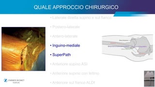 25
• Laterale diretta supino e sul fianco
• Postero-laterale
• Antero-laterale
• Inguino-mediale
• SuperPath
• Anteriore supino ASI
• Anteriore supino con lettino
• Anteriore sul fianco ALDI
QUALE APPROCCIO CHIRURGICO
 