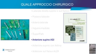 27
• Laterale diretta supino e sul fianco
• Postero-laterale
• Antero-laterale
• Inguino-mediale
• SuperPath
• Anteriore supino ASI
• Anteriore supino con lettino
• Anteriore sul fianco ALDI
QUALE APPROCCIO CHIRURGICO
 