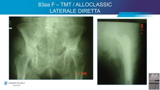 34
83aa F – TMT / ALLOCLASSIC
LATERALE DIRETTA
 