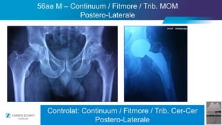 37
56aa M – Continuum / Fitmore / Trib. MOM
Postero-Laterale
Controlat: Continuum / Fitmore / Trib. Cer-Cer
Postero-Laterale
 