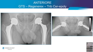 40
ANTERIORE
GTS – Regenerex – Trib Cer-epoly
 