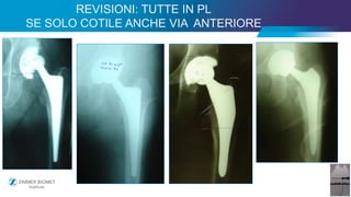 41
REVISIONI: TUTTE IN PL
SE SOLO COTILE ANCHE VIA ANTERIORE
 