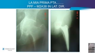 42
LA MIA PRIMA PTA…….
PPF – M2A38 IN LAT. DIR.
 