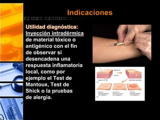 Indicaciones 
Inyección intradérmica 
de material tóxico o 
antigénico con el fin 
de observar si 
desencadena una 
respuesta inflamatoria 
local, como por 
ejemplo el Test de 
Mantoux, Test de 
Shick o la pruebas 
de alergia. 
 