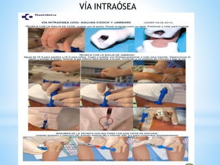 VÍA INTRAÓSEA
 