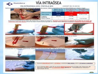 VÍA INTRAÓSEA
 