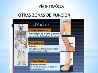 OTRAS ZONAS DE PUNCION
VÍA INTRAÓSEA
 