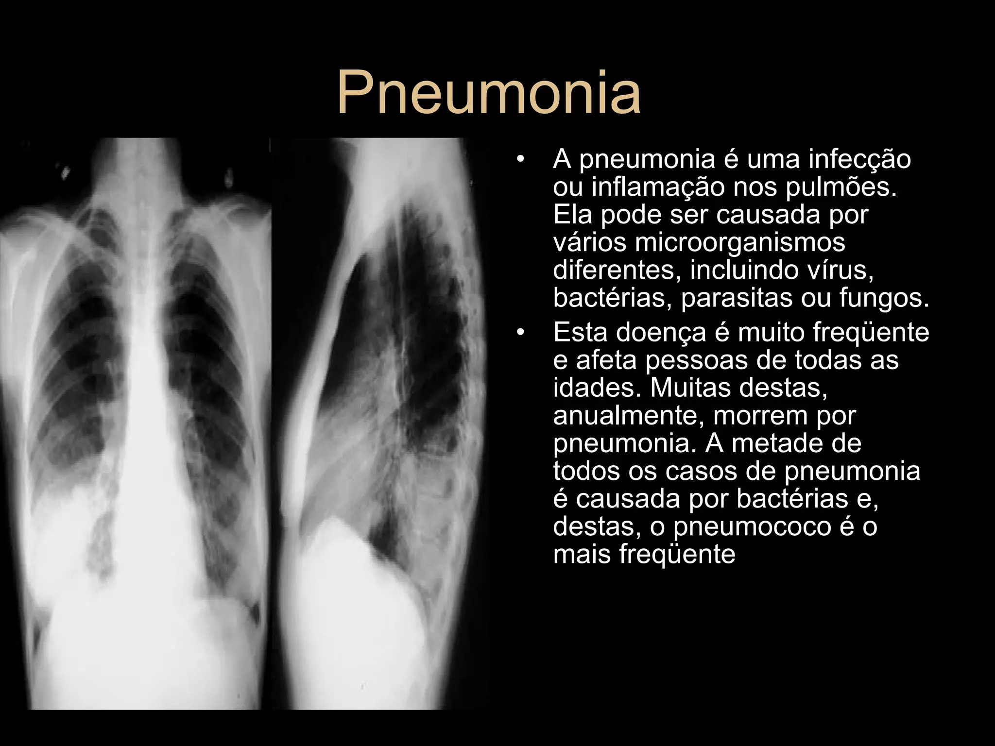 Pneumonia  A pneumonia é uma infecção ou inflamação nos pulmões. Ela pode ser causada por vários microorganismos diferentes, incluindo vírus, bactérias, parasitas ou fungos.  Esta doença é muito freqüente e afeta pessoas de todas as idades. Muitas destas, anualmente, morrem por pneumonia. A metade de todos os casos de pneumonia é causada por bactérias e, destas, o pneumococo é o mais freqüente 