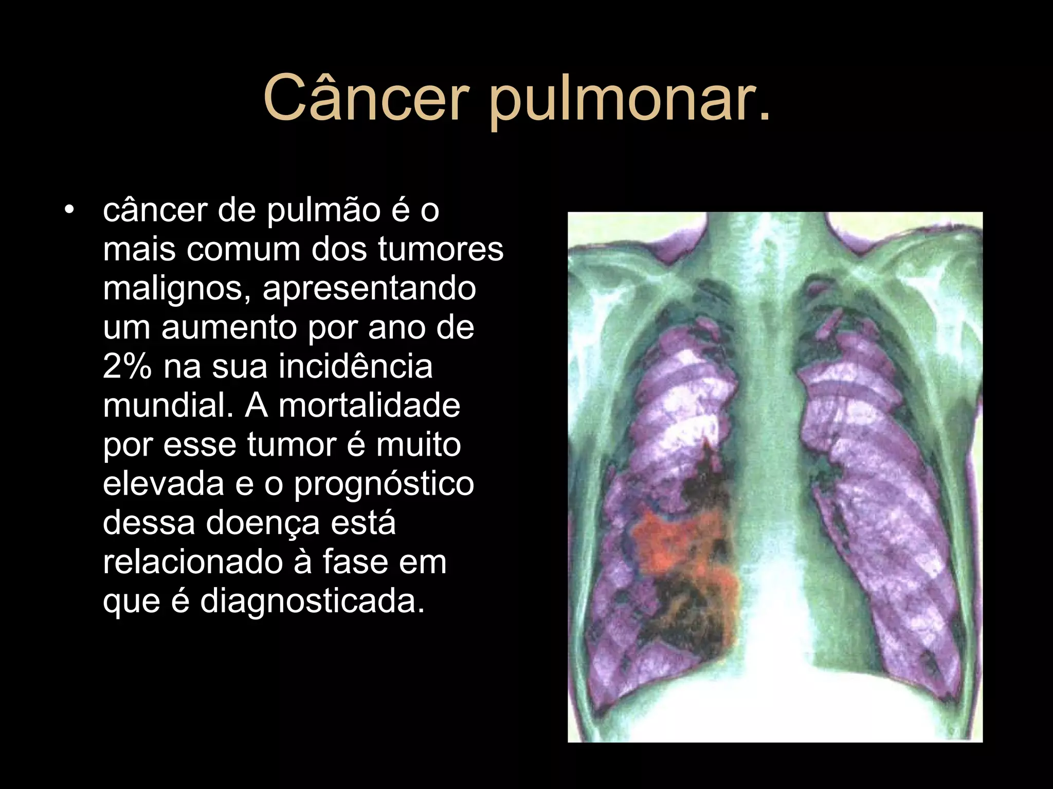 Câncer pulmonar.  câncer de pulmão é o mais comum dos tumores malignos, apresentando um aumento por ano de 2% na sua incidência mundial. A mortalidade por esse tumor é muito elevada e o prognóstico dessa doença está relacionado à fase em que é diagnosticada.  