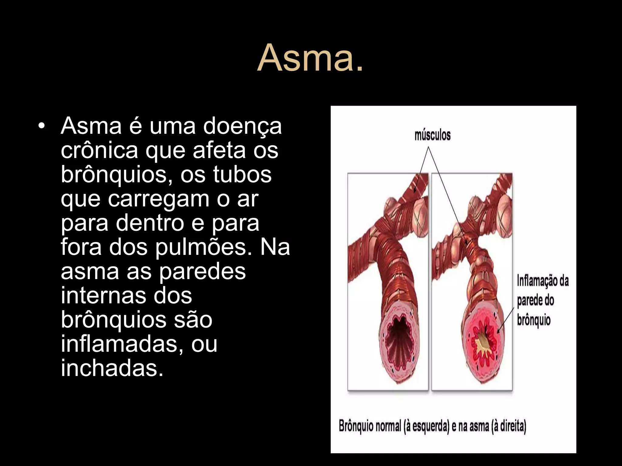 Asma. Asma é uma doença crônica que afeta os brônquios, os tubos que carregam o ar para dentro e para fora dos pulmões. Na asma as paredes internas dos brônquios são inflamadas, ou inchadas. 