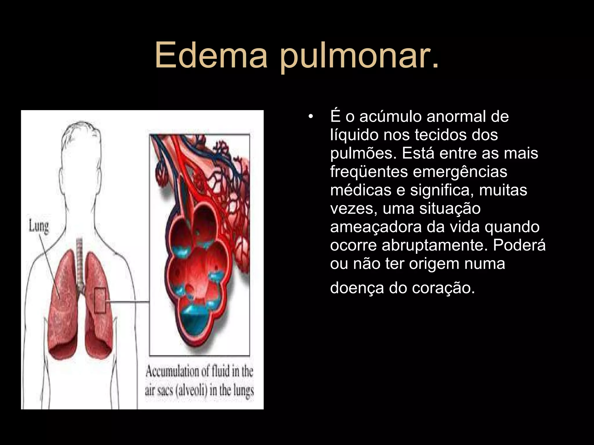 Edema pulmonar. É o acúmulo anormal de líquido nos tecidos dos pulmões. Está entre as mais freqüentes emergências médicas e significa, muitas vezes, uma situação ameaçadora da vida quando ocorre abruptamente. Poderá ou não ter origem numa doença do coração.   