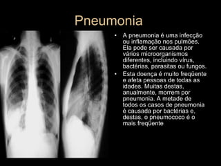 Pneumonia  A pneumonia é uma infecção ou inflamação nos pulmões. Ela pode ser causada por vários microorganismos diferentes, incluindo vírus, bactérias, parasitas ou fungos.  Esta doença é muito freqüente e afeta pessoas de todas as idades. Muitas destas, anualmente, morrem por pneumonia. A metade de todos os casos de pneumonia é causada por bactérias e, destas, o pneumococo é o mais freqüente 