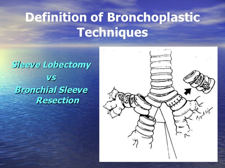 Lung Cancer An Overview & Discussion of Minimally Invasive Surgical
