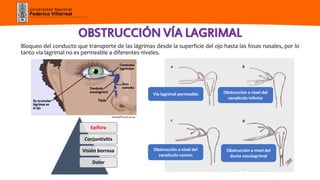 Universidad Nacional
Federico Villarreal
OBSTRUCCIÓN VÍA LAGRIMAL
Bloqueo del conducto que transporte de las lágrimas desde la superficie del ojo hasta las fosas nasales, por lo
tanto vía lagrimal no es permeable a diferentes niveles.
Vía lagrimal permeable Obstrucción a nivel del
canalículo inferior
Obstrucción a nivel del
canalículo común
Obstrucción a nivel del
ducto nasolagrimal
Epífora
Conjuntivitis
Visión borrosa
Dolor
 