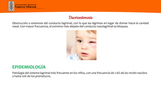 Universidad Nacional
Federico Villarreal
Dacrioestenosis
Obstrucción o estenosis del conducto lagrimal, con lo que las lágrimas en lugar de drenar hacia la cavidad
nasal. Con mayor frecuencia, el extremo más alejado del conducto nasolagrimal se bloquea.
EPIDEMIOLOGÍA
Patología del sistema lagrimal más frecuente en los niños, con una frecuencia de 2-6% de los recién nacidos
y hasta 20% de los prematuros.
 