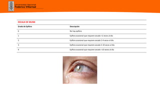 Universidad Nacional
Federico Villarreal
ESCALA DE MUNK
Grado de Epífora Descripción
0 No hay epífora
1 Epífora ocasional que requiere secado <2 veces al día
2 Epífora ocasional que requiere secado 2-4 veces al día
3 Epífora ocasional que requiere secada 5-10 veces al día
4 Epífora ocasional que requiere secado >10 veces al día
 