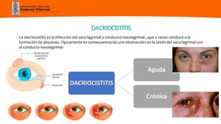 Universidad Nacional
Federico Villarreal
DACRIOCISTITIS
La dacriocistitis es la infección del saco lagrimal y conducto nasolagrimal , que a veces conduce a la
formación de abscesos. Típicamente es consecuencia de una obstrucción en la unión del saco lagrimal con
el conducto nasolagrimal.
DACRIOCISTITIS
Aguda
Crónica
 