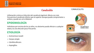 Universidad Nacional
Federico Villarreal
Canaliculitis
Inflamación crónica e infección del canalículo lagrimal. Afecta con más
frecuencia al canalículo inferior que al superior aunque puede comprometer a
ambos y puede ser uni o bilateral.
EPIDEMIOLOGÍA
Individuos por encima de los 50 años, no obstante puede afectar a cualquier
edad y es una afección poco frecuente.
ETIOLOGÍA
o Actinomices Israelii
o Herpes simple
o Cándida albicans
o Aspergillus
 