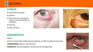 Universidad Nacional
Federico Villarreal
CLÍNICA
 Edema del canalículo
 Epífora
 Secreción que varía desde
acuosa a mucopurulenta, uni
o bilateral
 Ojo rojo
 Dolor al tacto
DIAGNÓSTICO
Clínico
Al hacer compresión medial al punto lagrimal, se observa salida de secreción
LABORATORIO: Cultivo y Tinción Gram
EXÁMENES: Dacriocistografía - Ultrasonido de vías lagrimales
 