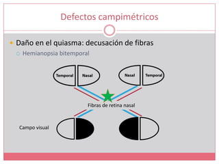 Defectos campimétricosDaño en el quiasma: decusación de fibrasHemianopsia bitemporalFibras de retina nasalCampo visual 