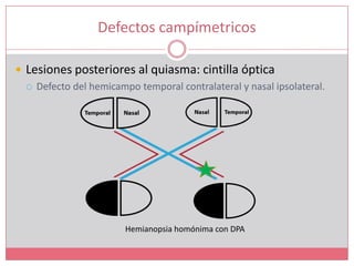 Defectos campímetricosLesiones posteriores al quiasma: cintilla ópticaDefecto del hemicampo temporal contralateral y nasal ipsolateral.Hemianopsia homónima con DPA