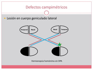 Defectos campimétricosLesión en cuerpo geniculado lateralHemianopsia homónima sin DPA