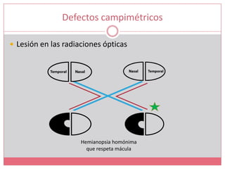 Defectos campimétricosLesión en las radiaciones ópticasHemianopsia homónimaque respeta mácula