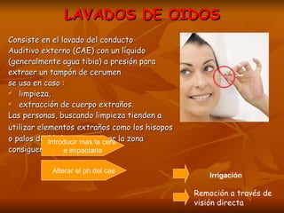 LAVADOS DE OIDOS Consiste en el lavado del conducto Auditivo externo (CAE) con un líquido (generalmente agua tibia) a presión para extraer un tampón de cerumen  se usa en caso : limpieza,  extracción de cuerpo extraños. Las personas, buscando limpieza tienden a  utilizar elementos   extraños como los hisopos o palos de fósforo para asear la zona  consiguen: puede realizarse a través de 2 técnicas: Irrigación Remoción a través de  visión directa Introducir más la cera  e impactarla Alterar el ph del cae 