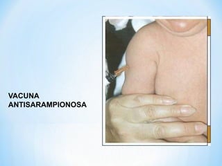 VACUNA
ANTISARAMPIONOSA
 