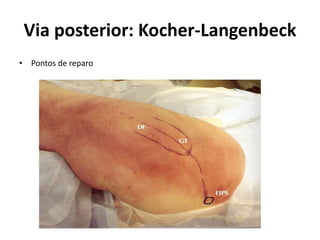 Via posterior: Kocher-Langenbeck
• Pontos de reparo
 