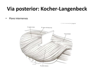 Via posterior: Kocher-Langenbeck
• Plano internervos
 