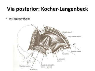 Via posterior: Kocher-Langenbeck
• Dissecção profunda
 