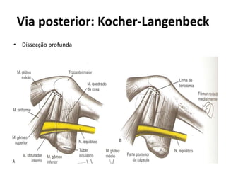 Via posterior: Kocher-Langenbeck
• Dissecção profunda
 