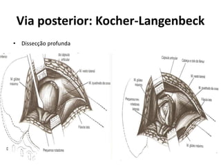 Via posterior: Kocher-Langenbeck
• Dissecção profunda
 