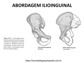 ABORDAGEM ILIOINGUINAL
https://traumatologiaeortopedia.com.br
 