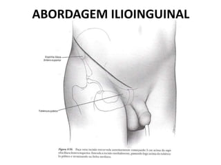 ABORDAGEM ILIOINGUINAL
 