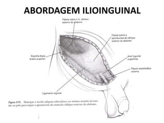 ABORDAGEM ILIOINGUINAL
 