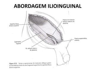 ABORDAGEM ILIOINGUINAL
 
