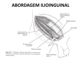 ABORDAGEM ILIOINGUINAL
 
