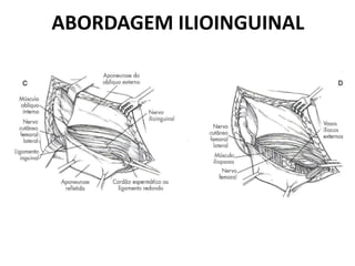 ABORDAGEM ILIOINGUINAL
 