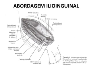 ABORDAGEM ILIOINGUINAL
 