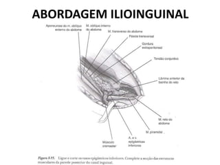 ABORDAGEM ILIOINGUINAL
 