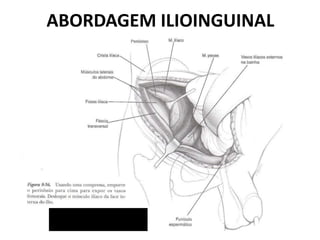 ABORDAGEM ILIOINGUINAL
 