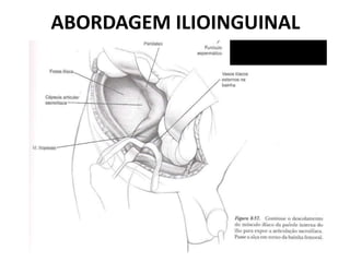 ABORDAGEM ILIOINGUINAL
 