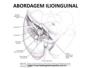 ABORDAGEM ILIOINGUINAL
https://traumatologiaeortopedia.com.br
 