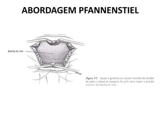 ABORDAGEM PFANNENSTIEL
 